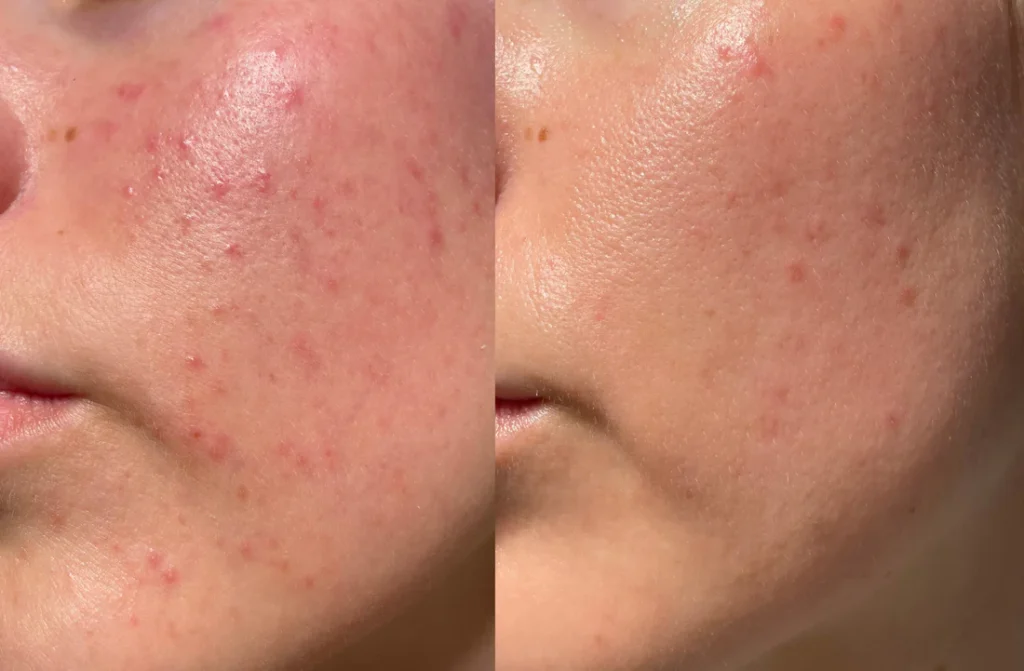 Chitosan for Skin Care