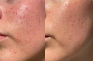 Chitosan for Skin Care